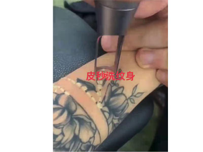 超皮秒洗纹身